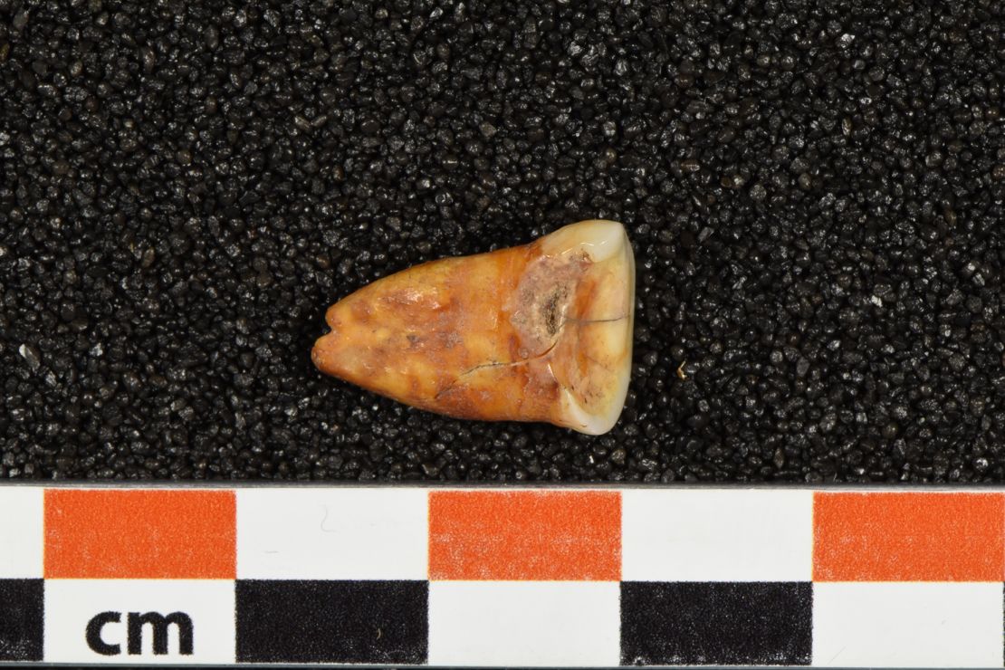 A human tooth unearthed from Taforalt Cave in Morocco shows severe wear and caries, or cavities.