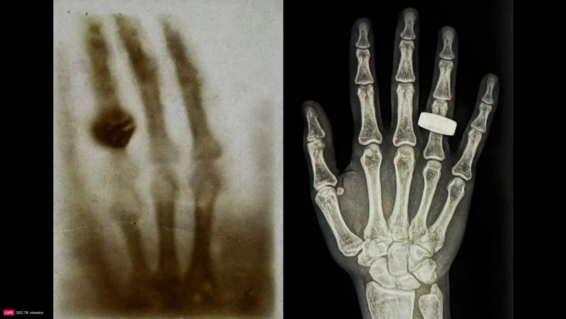 La primera radiografía jamás capturada de una mano humana (izquierda) se compara con la primera radiografía creada en el espacio durante la misión Fram2 en esta captura de pantalla de video.