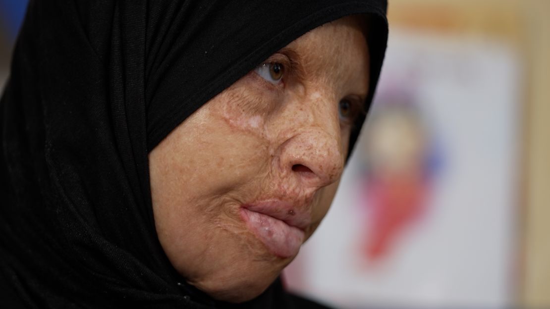 Sanaa Abu Tabaq, who suffered burns as a child, saw her husband and daughter shot dead during the November ceasefire in Gaza.