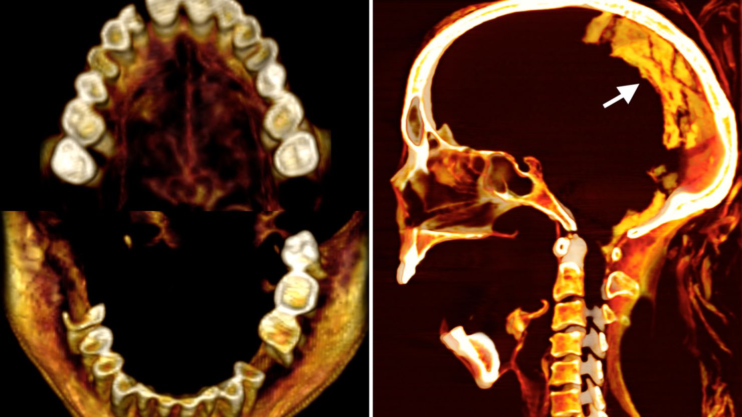 CT scans, including of the teeth (left) and brain, helped reveal new details about a mummified Egyptian woman’s morphology, health conditions and preservation.