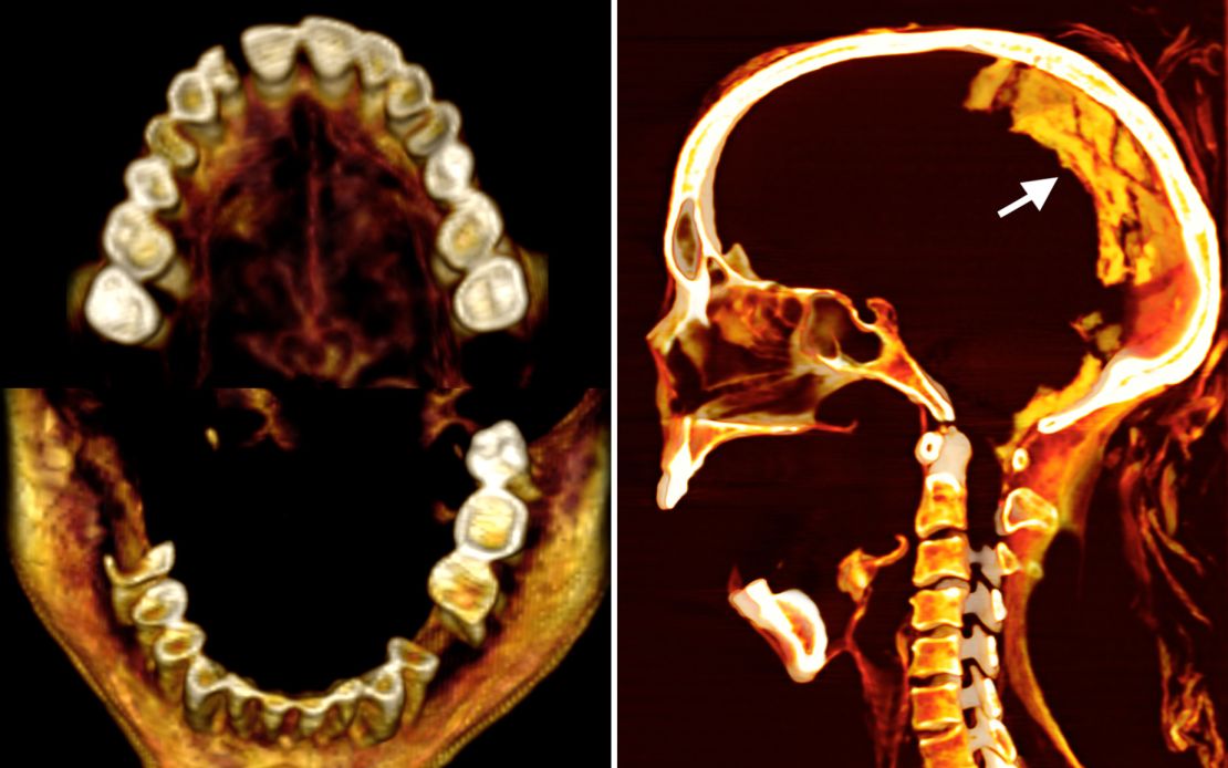 CT scans, including of the teeth (left) and brain, have revealed new details about the mummy’s morphology, health conditions and preservation.
