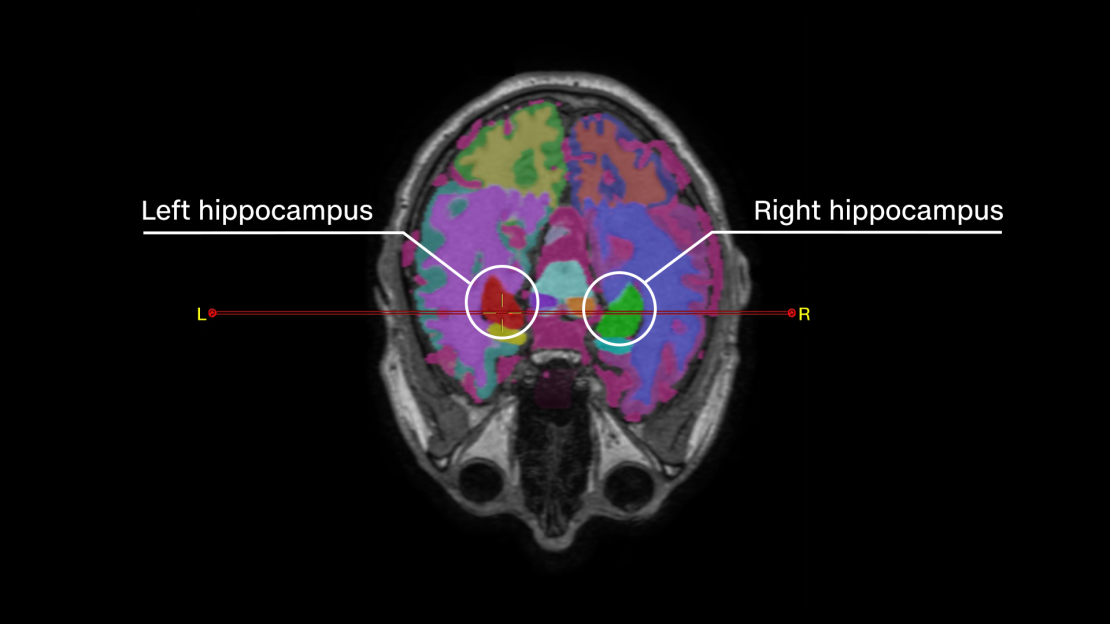 A brain volume image showing the increased size of Nicholls' hippocampus.