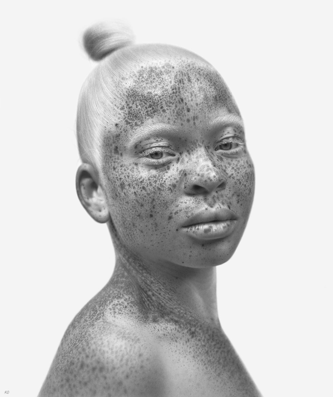 Shimbe Avalumun Queen has albinism and promotes inclusion of people with the condition, especially in Africa.