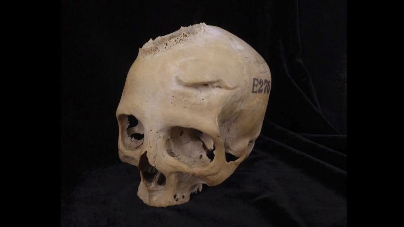 Доказателство за хирургично отстраняване на тумор в черепа на древен Египет е „крайъгълен камък в историята на медицината“