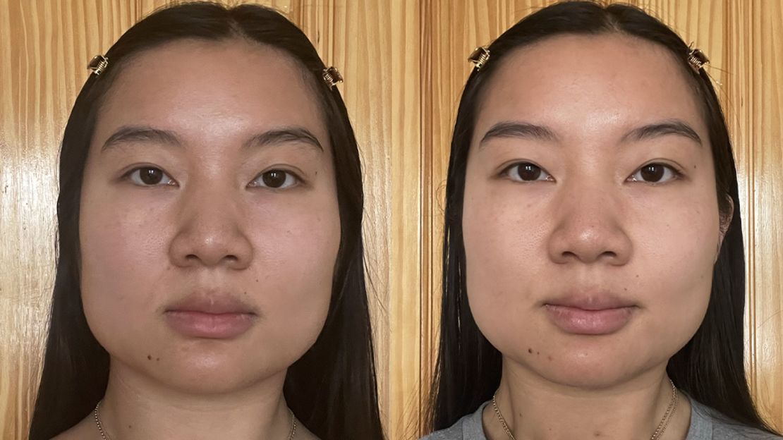 Before using the Pure Lift Face (left) and after using the Pure Lift Face every day for two weeks (right).