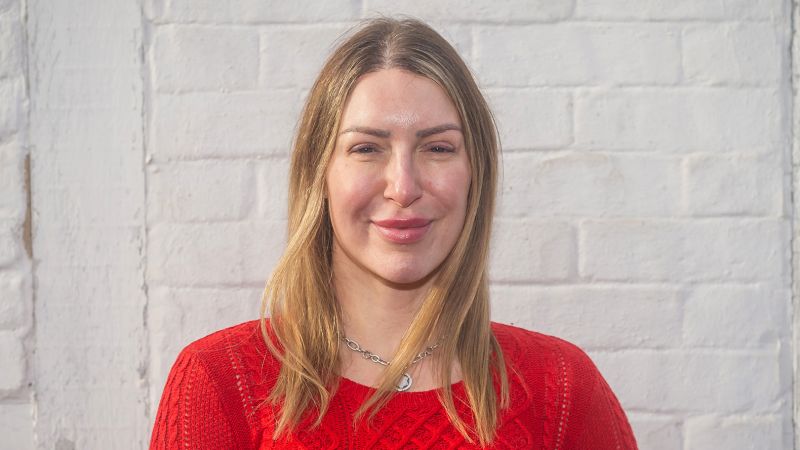 Hair transplants for women are booming. Their success rate is complicated