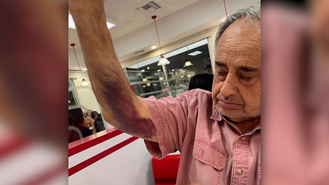 Rafie muestra los moretones en su cuerpo luego del operativo de inmigración en su negocio.
