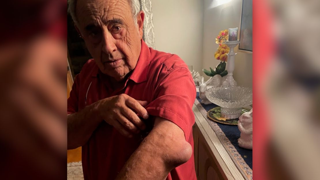 Rafie Shouhed muestra cómo se lastimó el codo durante el operativo de inmigración.