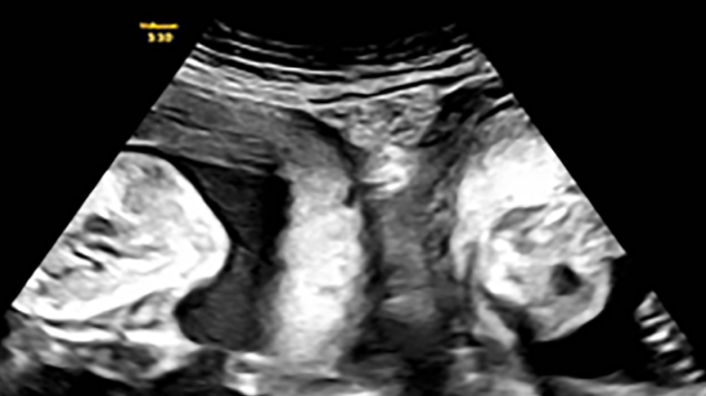 The hospital released this ultrasound image it said was taken during Li's pregnancy