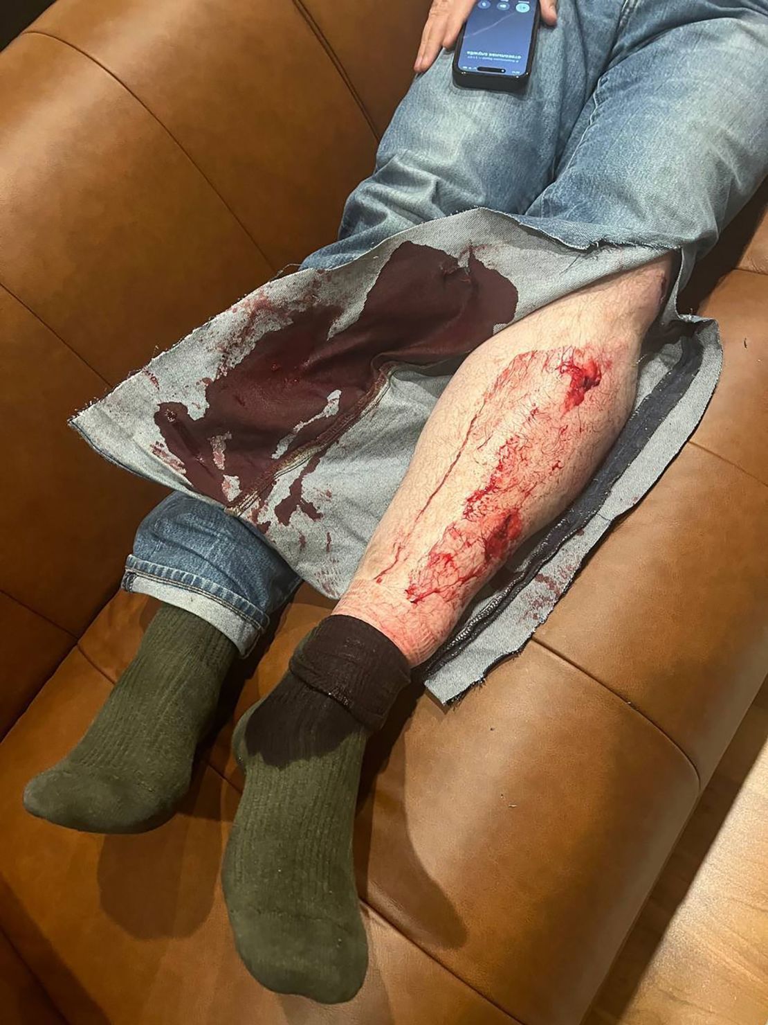 Leonid Volkov's injuries after he was attacked with a hammer outside his home.