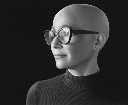 Zelda Burborough, a campaigner for the non-profit Changing Faces, has alopecia. “When I saw my portrait for the first time, it allowed me to look at it separately from my identity and to appreciate the beauty of the work of art, but also to truly see myself,” she told CNN. “It makes you realize that it's our flaws that make us beautiful, make us different.”