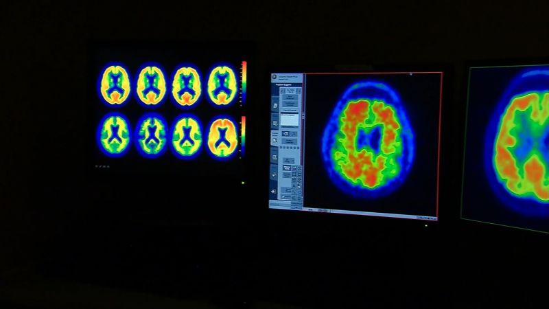Estas señales podrían salvar tu vida ante un derrame cerebral | cnn