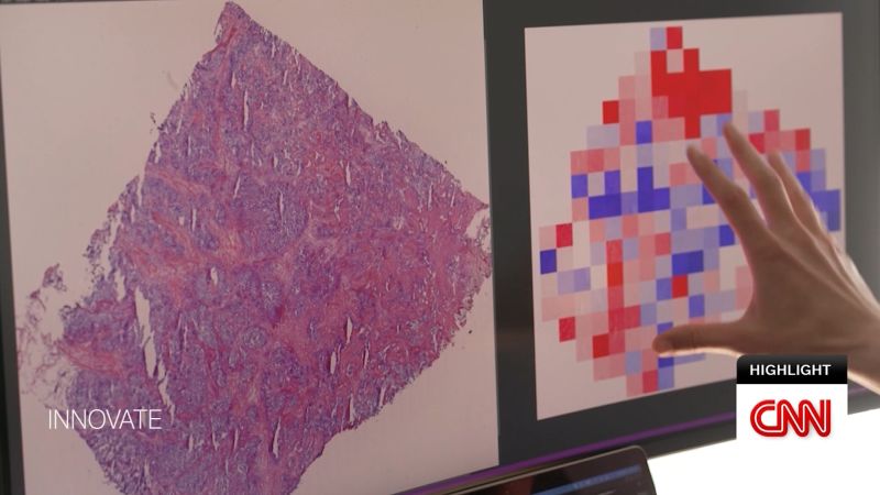 How an AI program could personalize breast and ovarian cancer care