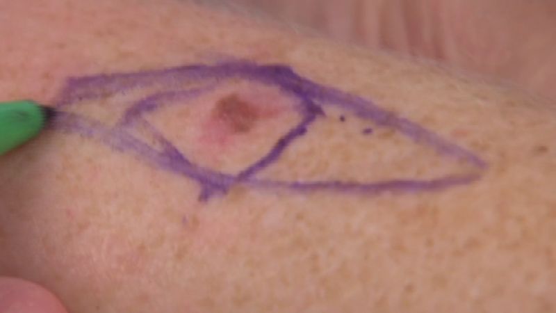 Estudio busca derribar mito sobre el color de la piel y los melanoma | cnn